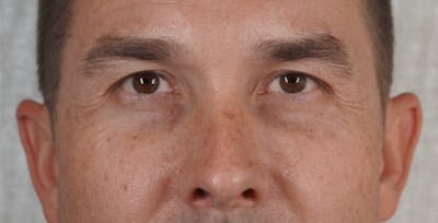 Halo Laser Before & After Gallery - Patient 123774590 - Image 1