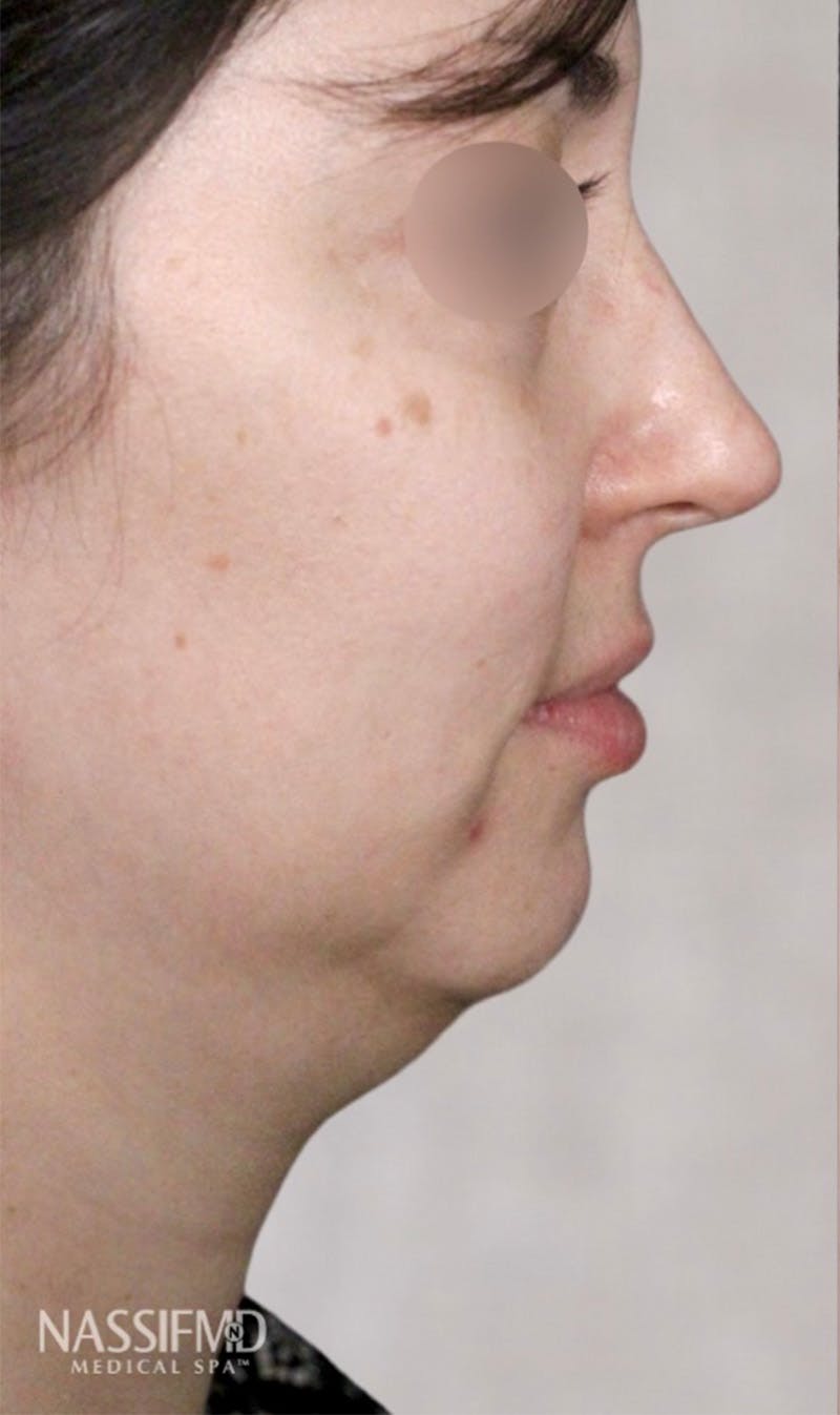 Kybella Before & After Gallery - Patient 123774593 - Image 1