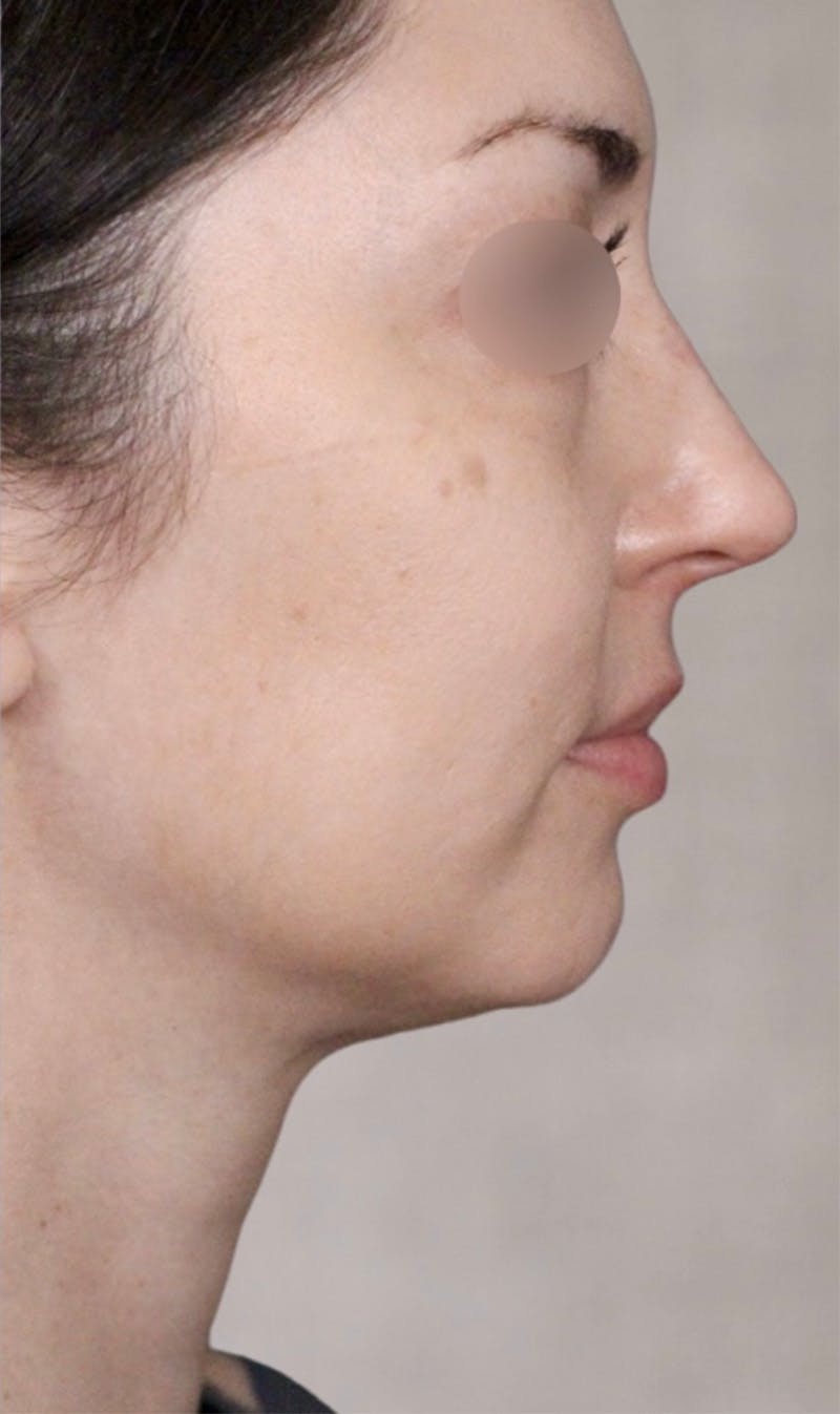 Kybella Before & After Gallery - Patient 123774593 - Image 2