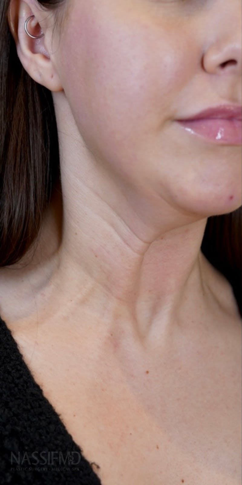 BOTOX Before & After Gallery - Patient 146644039 - Image 1