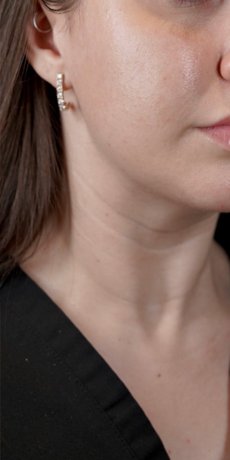 BOTOX Before & After Gallery - Patient 146644039 - Image 2