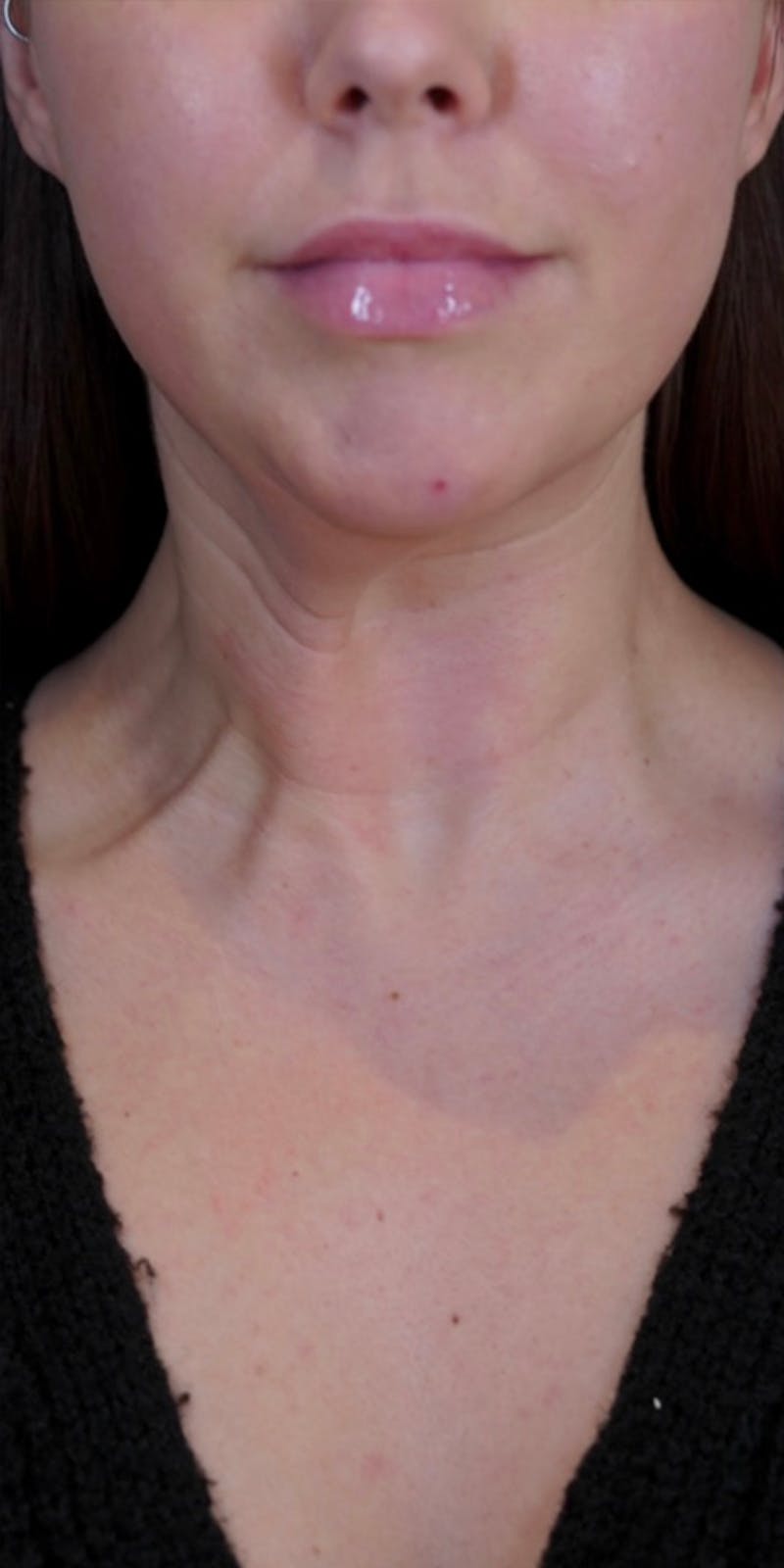 BOTOX Before & After Gallery - Patient 146644039 - Image 3
