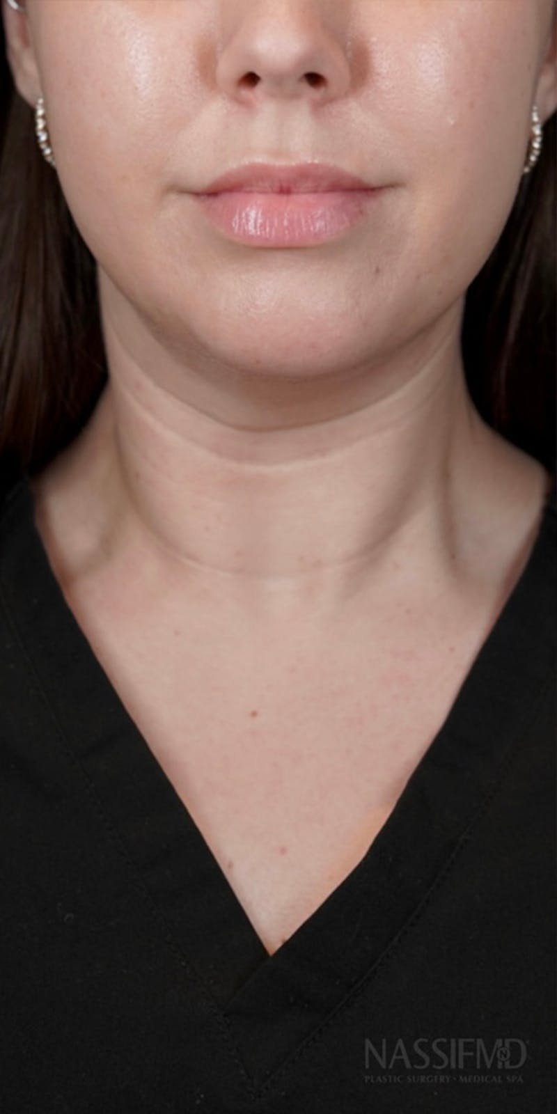 BOTOX Before & After Gallery - Patient 146644039 - Image 4