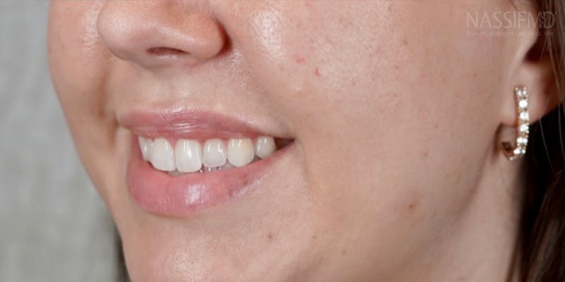 BOTOX Before & After Gallery - Patient 146644040 - Image 2