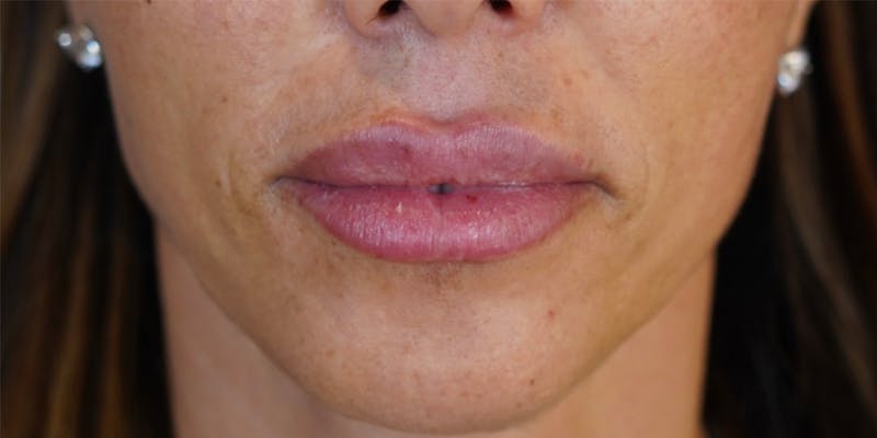 BOTOX Before & After Gallery - Patient 146644043 - Image 1