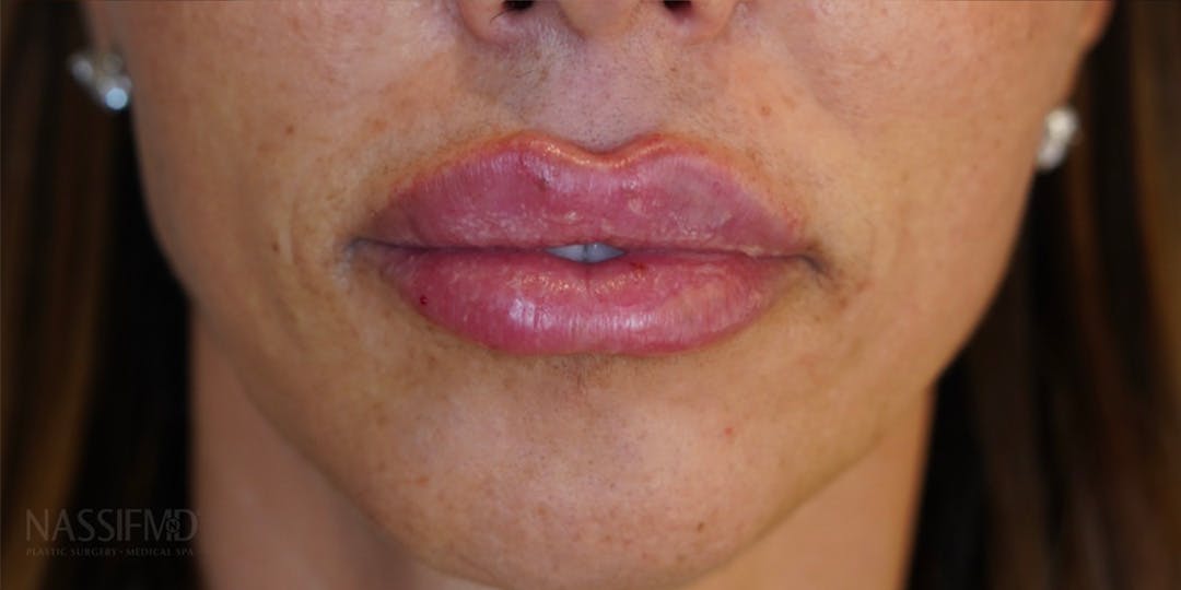 BOTOX Before & After Gallery - Patient 146644043 - Image 2