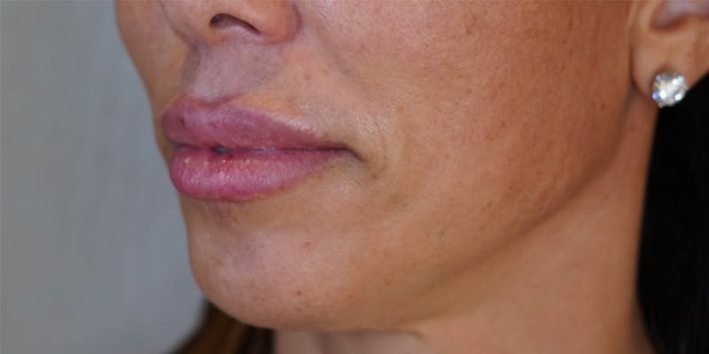 BOTOX Before & After Gallery - Patient 146644043 - Image 3