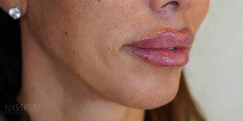 BOTOX Before & After Gallery - Patient 146644043 - Image 6