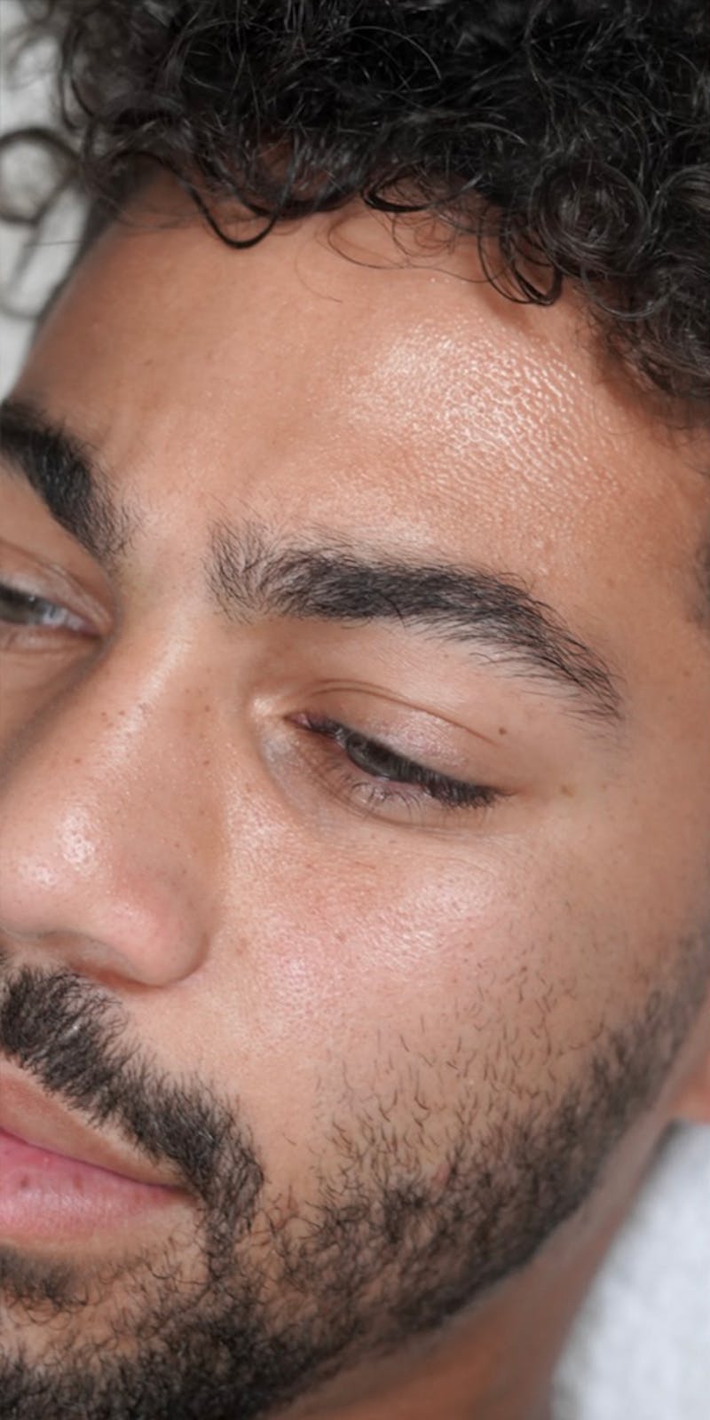 Hydrafacial Before & After Gallery - Patient 146644048 - Image 3