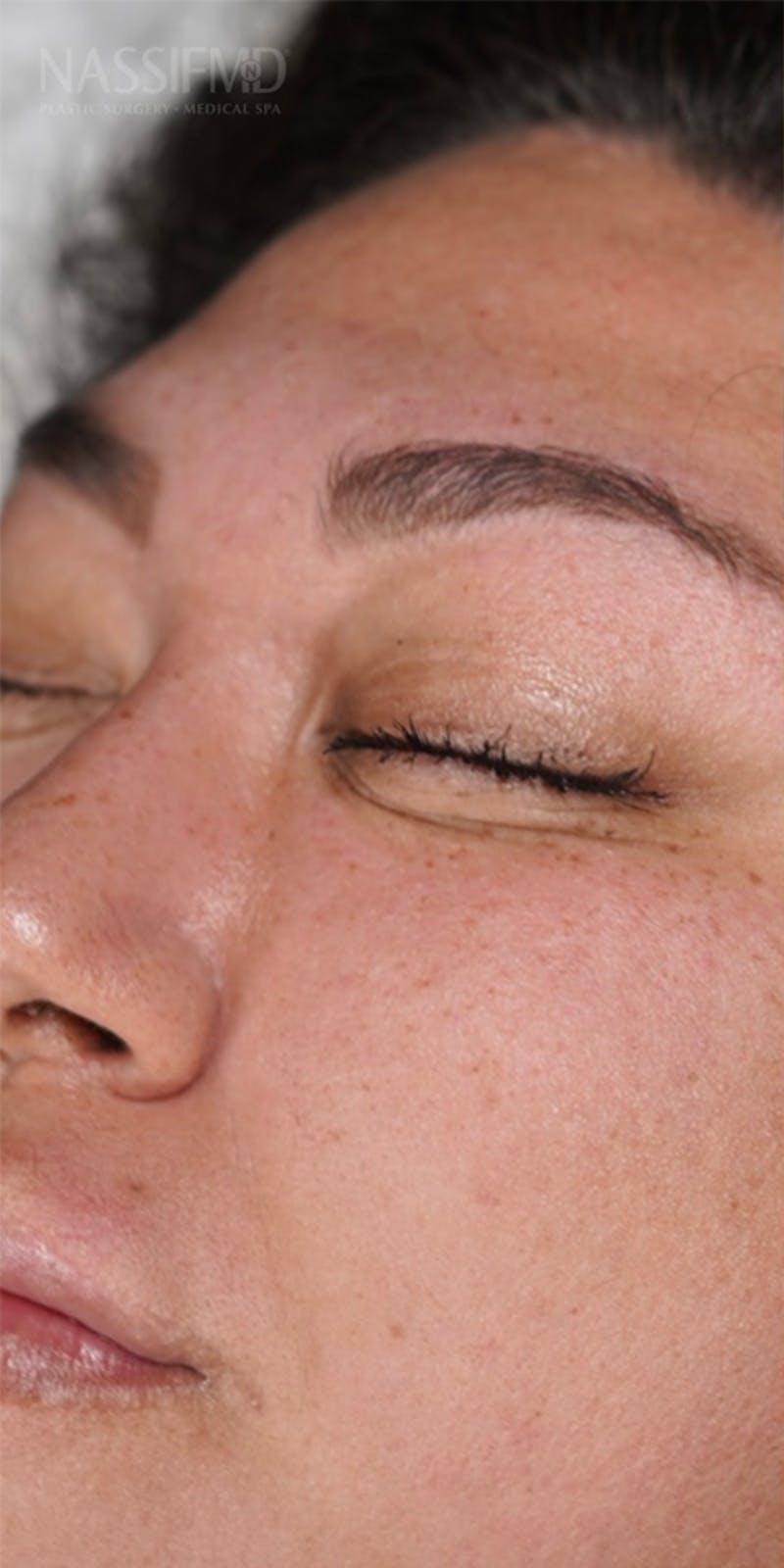 Hydrafacial Before & After Gallery - Patient 146644047 - Image 1