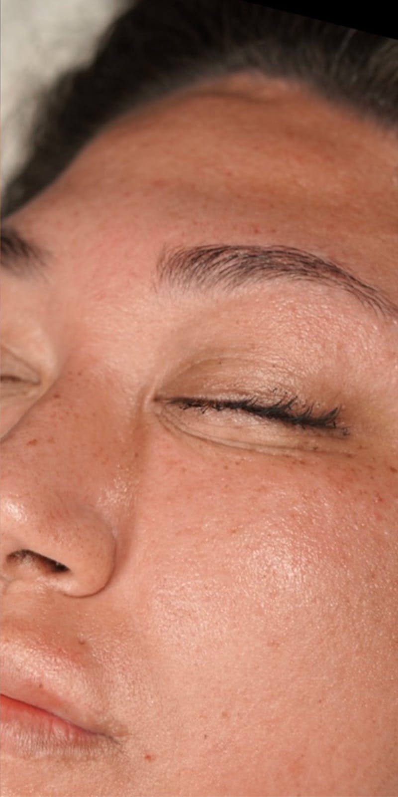 Hydrafacial Before & After Gallery - Patient 146644047 - Image 2