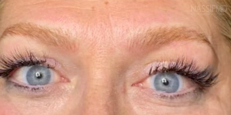 Microblading Before & After Gallery - Patient 146644071 - Image 2