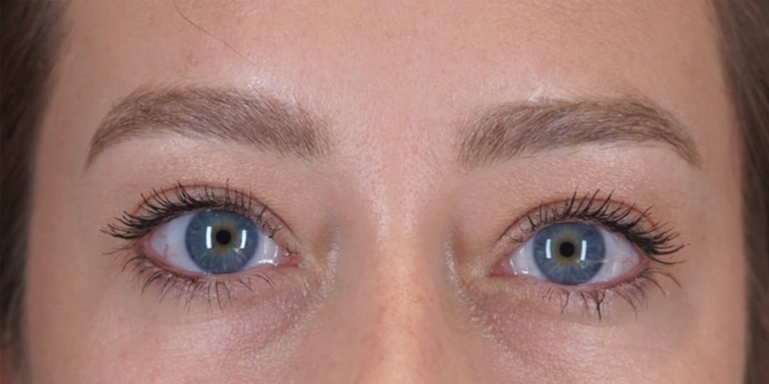 Microblading Before & After Gallery - Patient 146644070 - Image 1