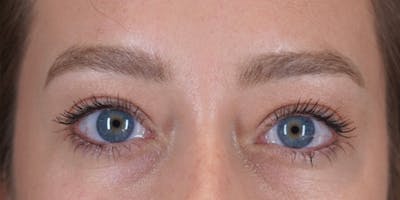 Microblading Before & After Gallery - Patient 146644070 - Image 1