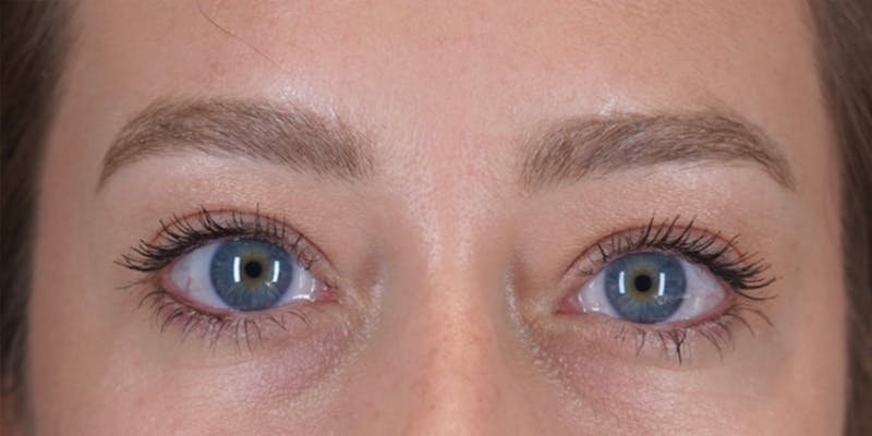 Microblading Before & After Gallery - Patient 146644070 - Image 1