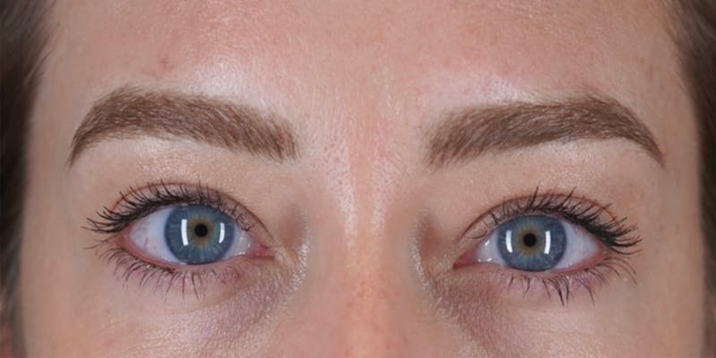 Microblading Before & After Gallery - Patient 146644070 - Image 2