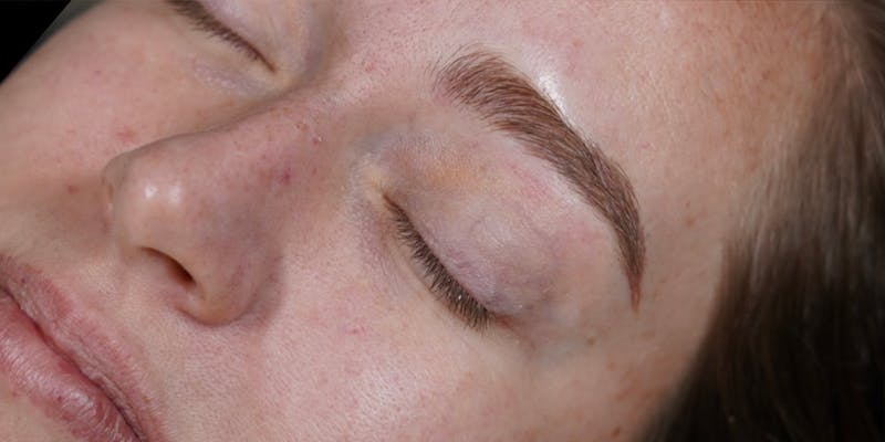 Microblading Before & After Gallery - Patient 146644070 - Image 4