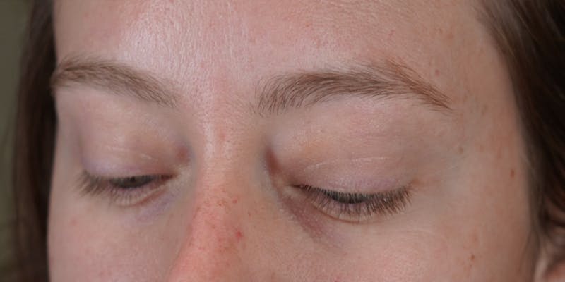 Microblading Before & After Gallery - Patient 146644070 - Image 5