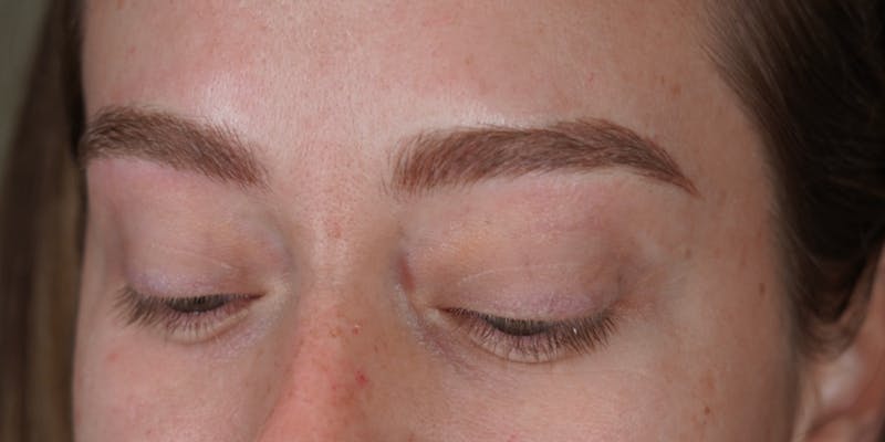 Microblading Before & After Gallery - Patient 146644070 - Image 6