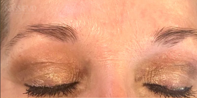 Microblading Before & After Gallery - Patient 146644069 - Image 1