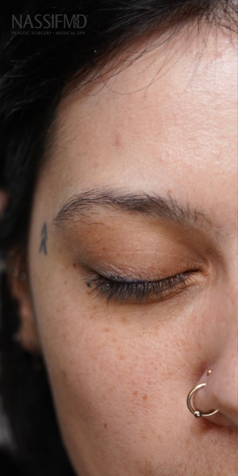 Microblading Before & After Gallery - Patient 146644195 - Image 1