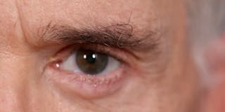 Lower Blepharoplasty Before & After Gallery - Patient 147536676 - Image 4