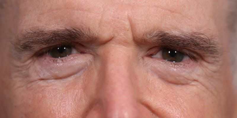 Lower Blepharoplasty Before & After Gallery - Patient 147536676 - Image 1