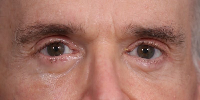 Lower Blepharoplasty Before & After Gallery - Patient 147536676 - Image 2