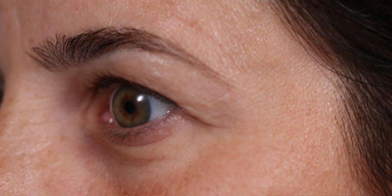 Upper Blepharoplasty Before & After Gallery - Patient 147536699 - Image 3