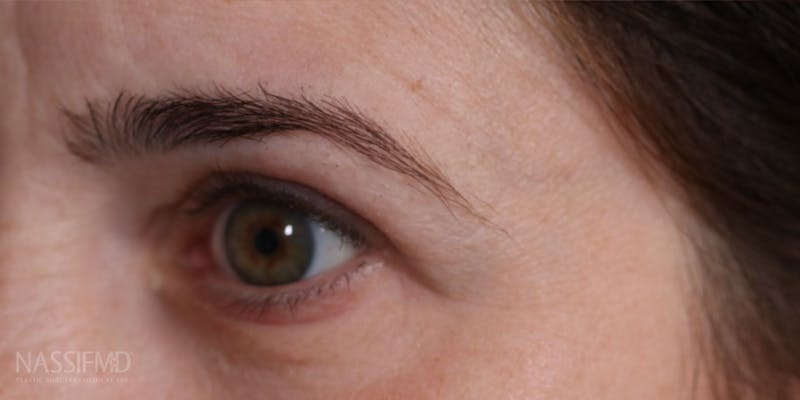 Upper Blepharoplasty Before & After Gallery - Patient 147536699 - Image 4