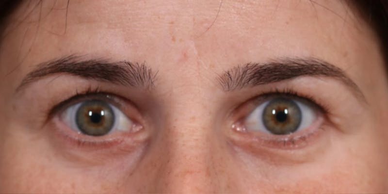 Upper Blepharoplasty Before & After Gallery - Patient 147536699 - Image 1