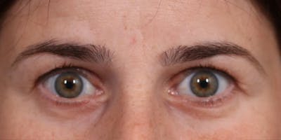 Upper Blepharoplasty Before & After Gallery - Patient 147536699 - Image 1