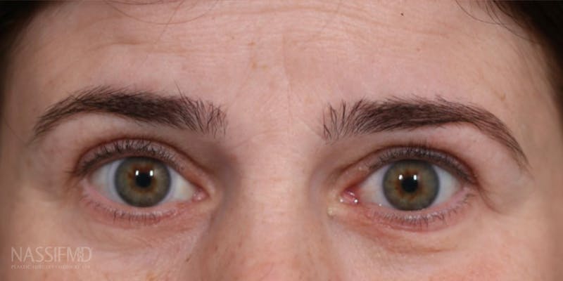 Upper Blepharoplasty Before & After Gallery - Patient 147536699 - Image 2