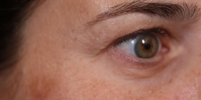 Upper Blepharoplasty Before & After Gallery - Patient 147536699 - Image 5