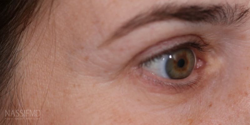 Upper Blepharoplasty Before & After Gallery - Patient 147536699 - Image 6
