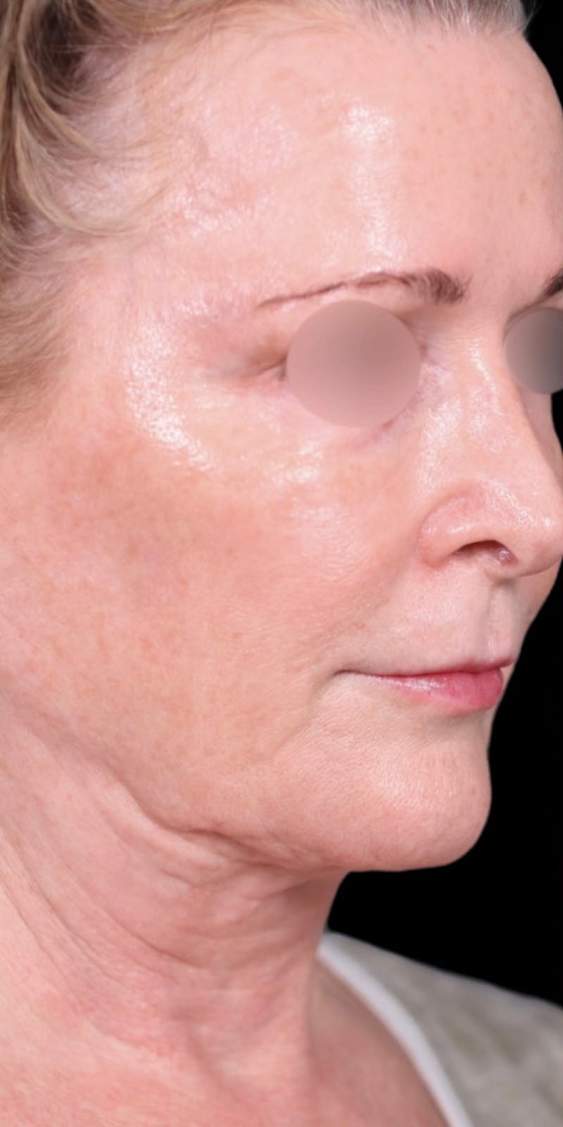 Facelift Before & After Gallery - Patient 147536703 - Image 1