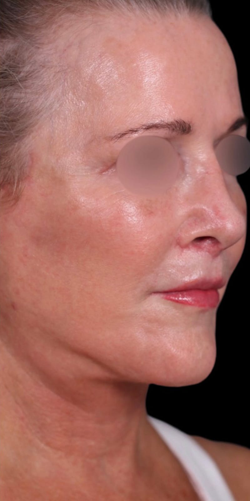 Facelift Before & After Gallery - Patient 147536703 - Image 2