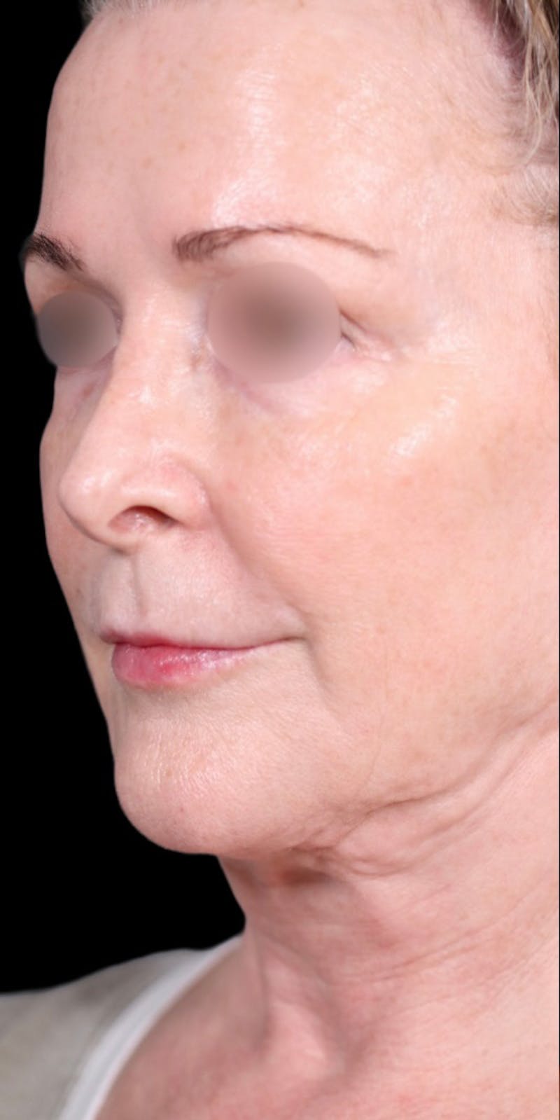 Facelift Before & After Gallery - Patient 147536703 - Image 3