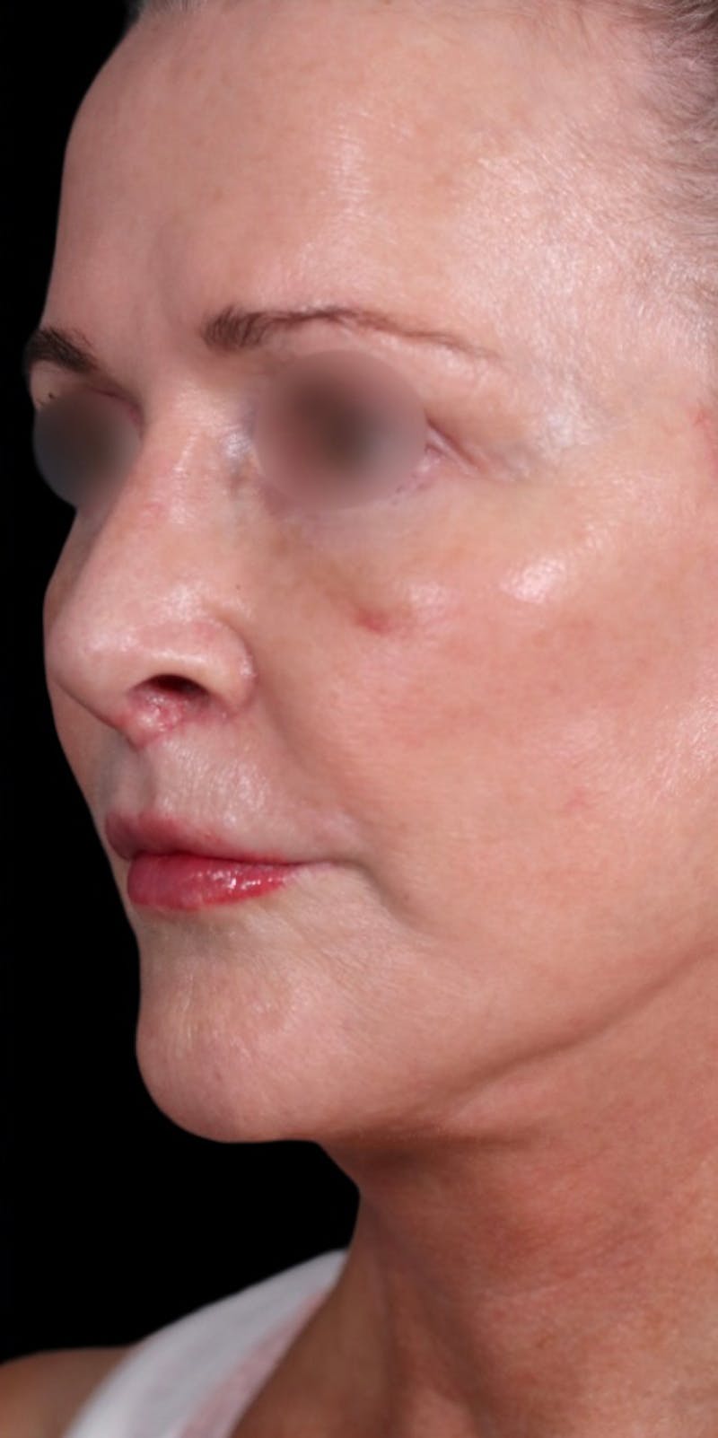 Facelift Before & After Gallery - Patient 147536703 - Image 4