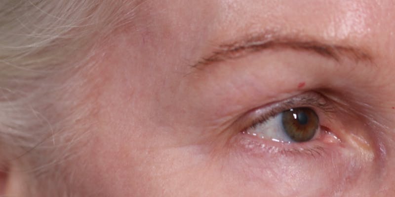 Upper Blepharoplasty Before & After Gallery - Patient 147537727 - Image 3