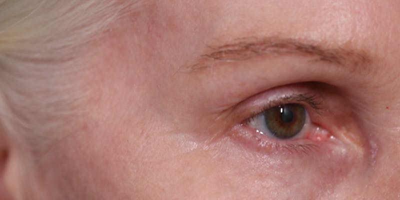 Upper Blepharoplasty Before & After Gallery - Patient 147537727 - Image 4