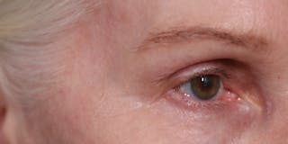 Upper Blepharoplasty Before & After Gallery - Patient 147537727 - Image 4