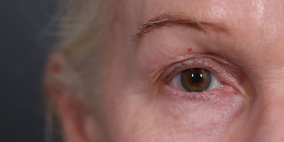 Upper Blepharoplasty Before & After Gallery - Patient 147537727 - Image 1