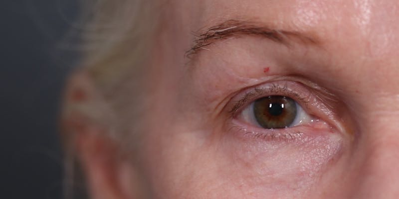 Upper Blepharoplasty Before & After Gallery - Patient 147537727 - Image 1
