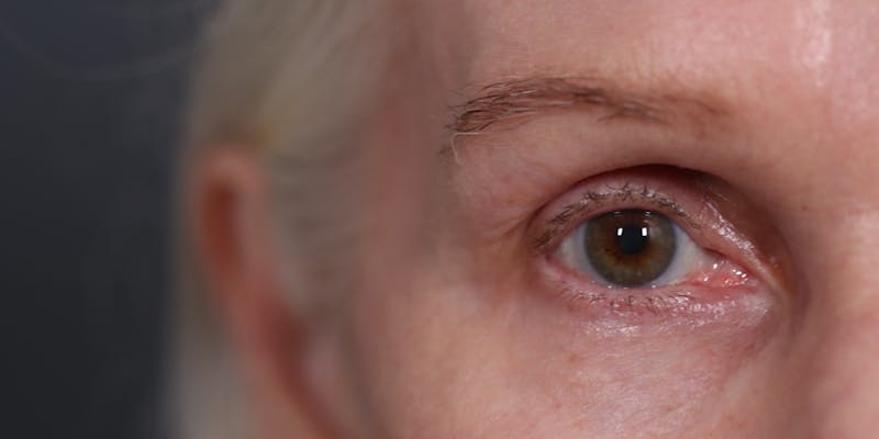 Upper Blepharoplasty Before & After Gallery - Patient 147537727 - Image 2