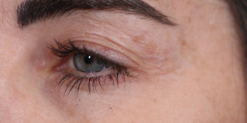 Upper Blepharoplasty Before & After Gallery - Patient 147537726 - Image 3