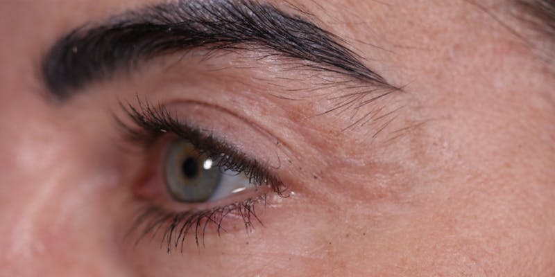 Upper Blepharoplasty Before & After Gallery - Patient 147537726 - Image 4