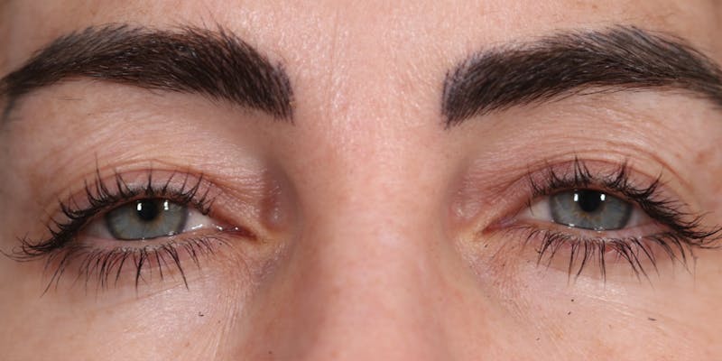 Upper Blepharoplasty Before & After Gallery - Patient 147537726 - Image 1