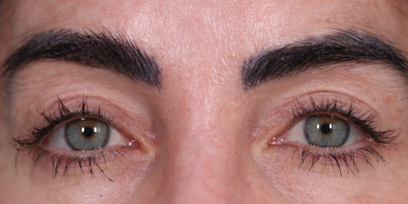 Upper Blepharoplasty Before & After Gallery - Patient 147537726 - Image 2