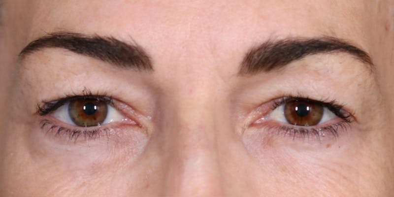 Upper Blepharoplasty Before & After Gallery - Patient 147537725 - Image 1